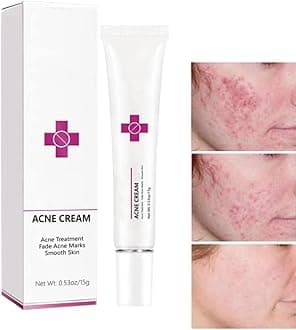 Acne Cream Pimple Cream for Face, Oil Control Pimple Remover Cream Get Rid of Pimples Fast,for Oily and Acne Prone Skin, Cruelty Free, Crema para espinillas en la cara