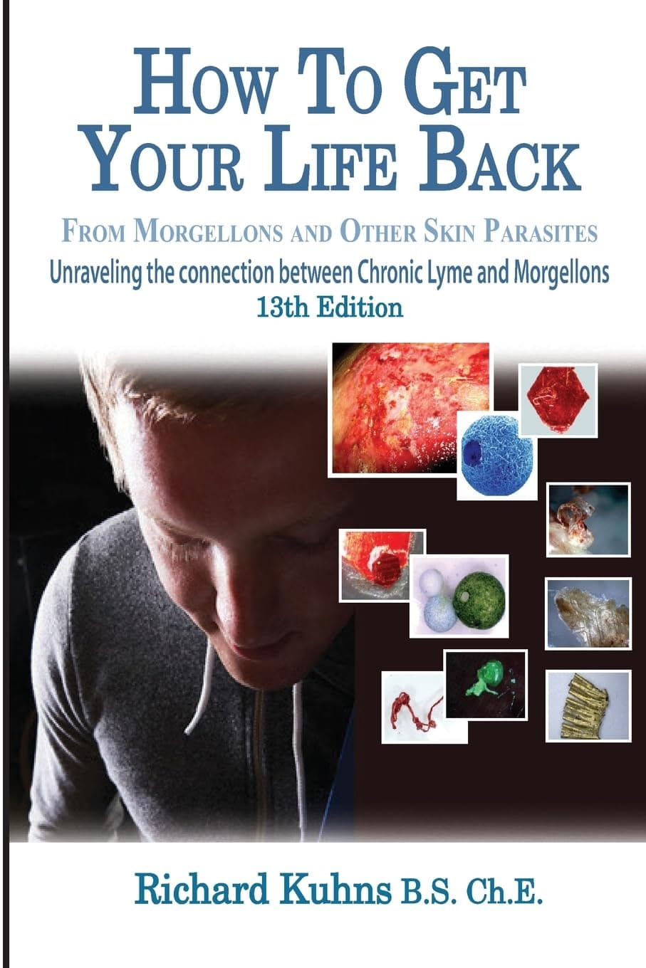 How to Get Your Life Back From Morgellons and Other Skin Parasites Limited Edit